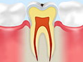 C0：初期の虫歯