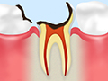 C4：歯根の虫歯
