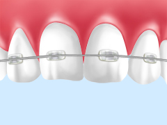 部分矯正とは？