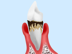 歯周病について正しく理解しましょう～歯周病～