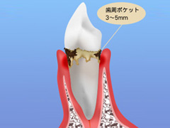 2.歯肉炎（軽度歯周炎）