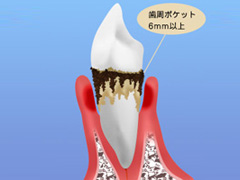 4.周囲の骨が溶ける（重度歯周炎）