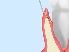 歯周ポケット掻破（そうは）術